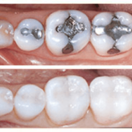 Amalgam Removal