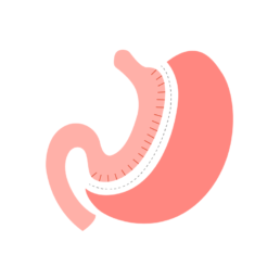 Gastric Sleeve