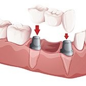 Dental Bridges
