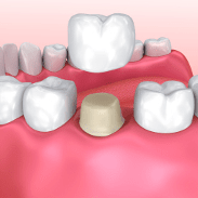 Dental Crown