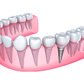 Dental Implants