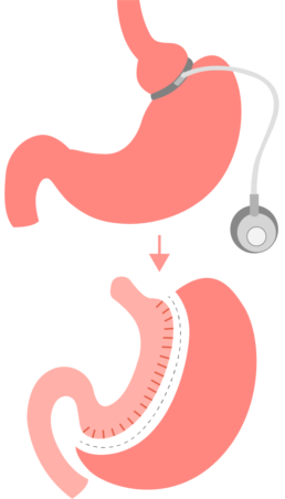 Revision Surgery