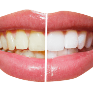 Teeth Whitening