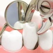 Tooth Extraction
