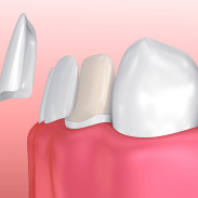 Dental Veneer